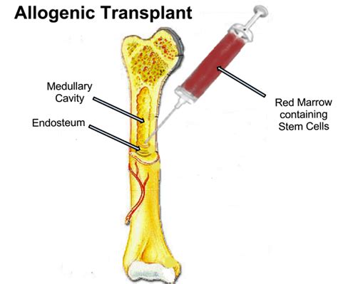 Bone Marrow Transplantation in Practice Doc