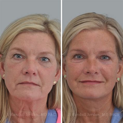 Botched Mini Face Lifts: The Numbers Don't Lie