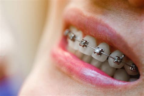 Braces: