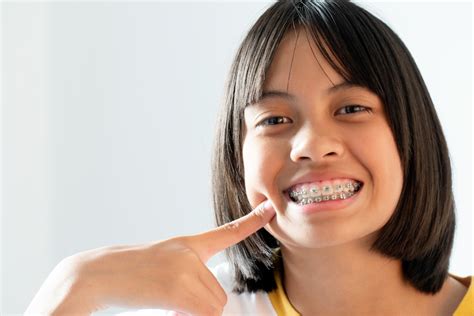 Braces Student Price Singapore: A Comprehensive Guide to Achieving Your Perfect Smile at a Pocket-Friendly Cost