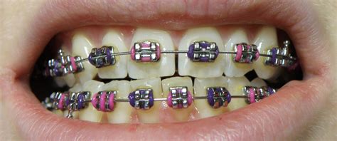 Braces for Teens: Why You Need Them and How They Can Improve Your Smile