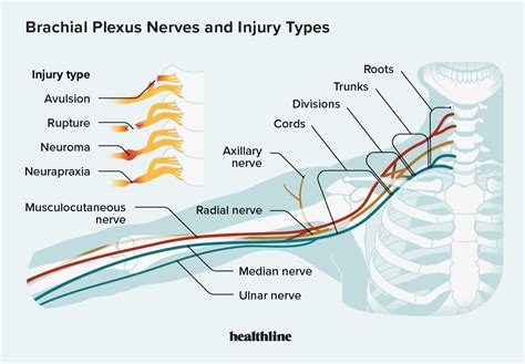 Brachial Plexus Injuries PDF