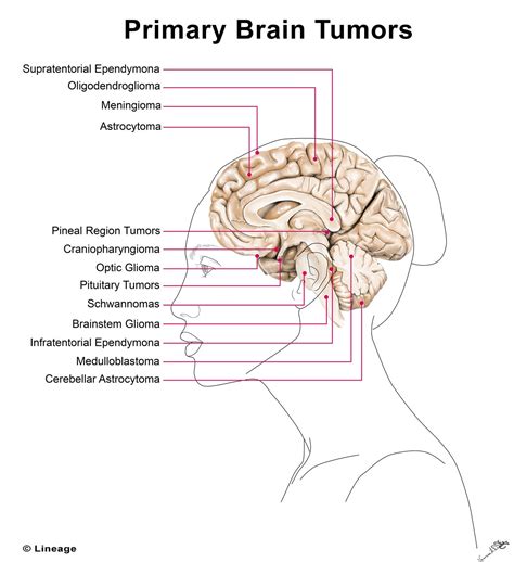 Brain Tumors Doc