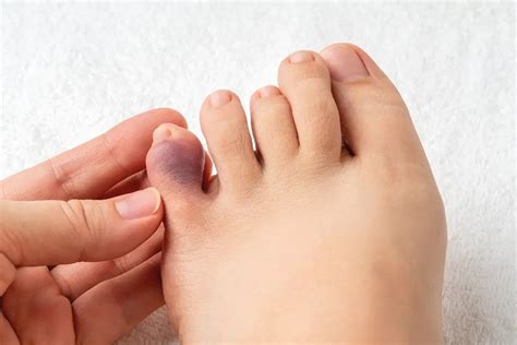 Broken Pinky Toe: A Comprehensive Guide to Healing and Recovery