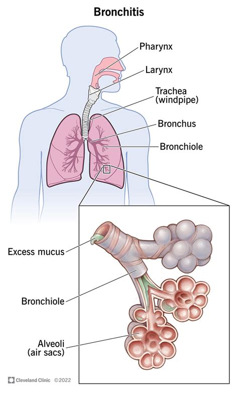 Bronchitis: