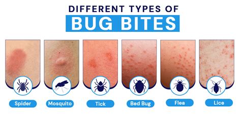 Bug Bite Pokémon: The Ultimate Guide to Biting Insects