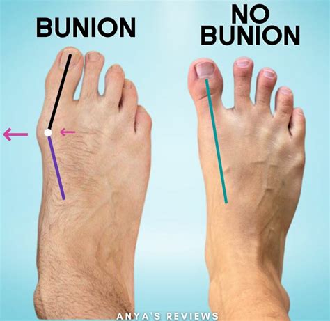 Bunions