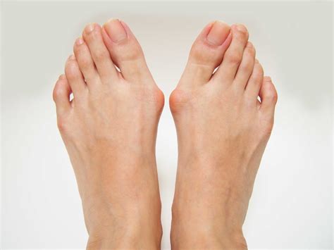 Bunions: