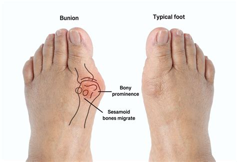 Bunions and hammertoes: