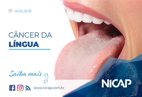 Câncer da Língua: Sintomas, Diagnóstico e Tratamento