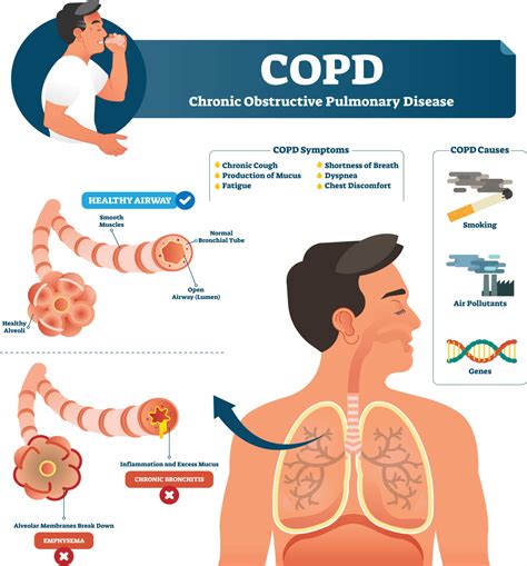 COPD A Guide to Diagnosis and Clinical Management Reader