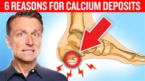 Calcification: Unraveling the Mysteries of Calcium Deposits in the Body