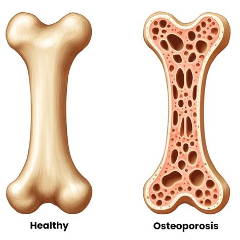 Calcit 2025: Enhancing Bone Health vs. Osteoporosis