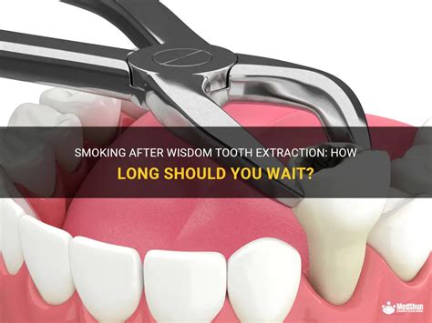 Can I Smoke Nicotine After Wisdom Teeth Removal? What You Need to Know