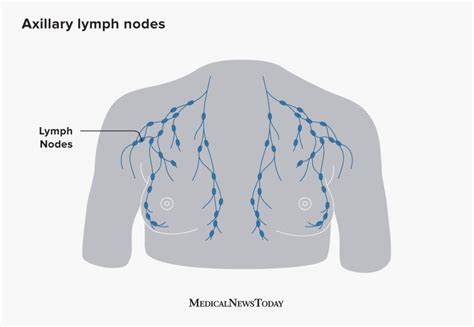 Cancer Pictures of Swollen Lymph Nodes in Armpit