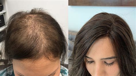 Cancer and Hair Loss