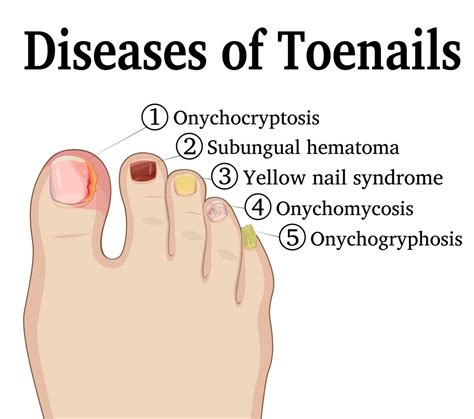 Cancer and Toenails