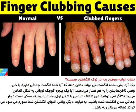 Cancer at Your Fingertips Doc