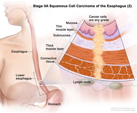 Cancer of the Esophagus, Vol. 2 Reader