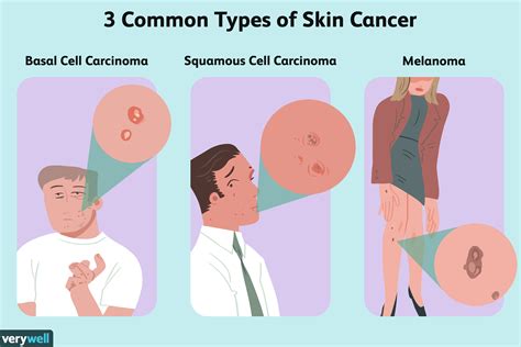 Cancerous Growth on Leg: An Overview of 3 Common Types