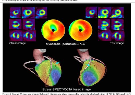 Cardiac Spect Imaging Reader