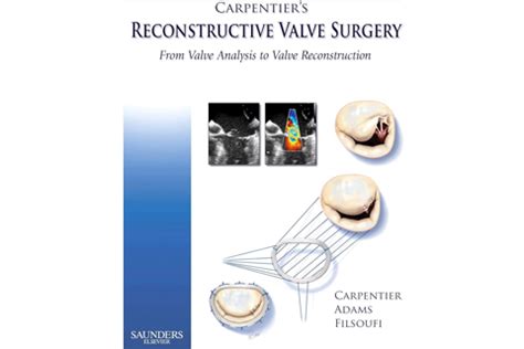 Carpentiers Reconstructive Valve Surgery: From Valve Analysis to Valve Reconstruction Ebook PDF