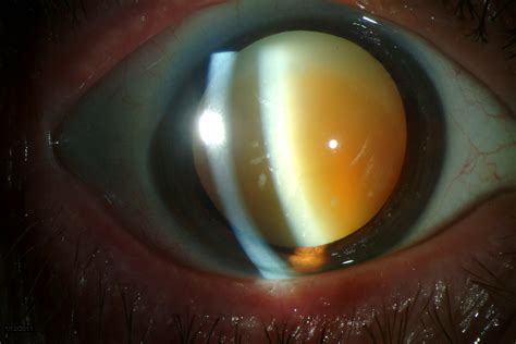 Cataract Epub