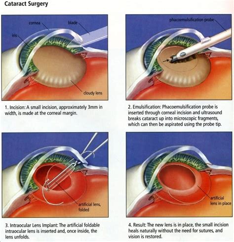Cataract Some Notes After Having a Cataract Removed PDF