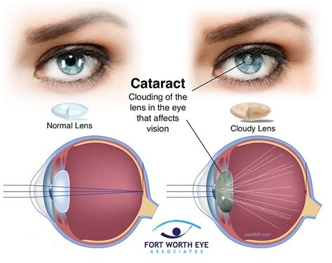 Cataracts: