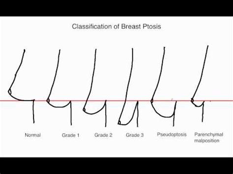 Causes and Symptoms of Pendulous Breasts