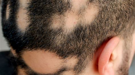 Causes of Bald Head Patches