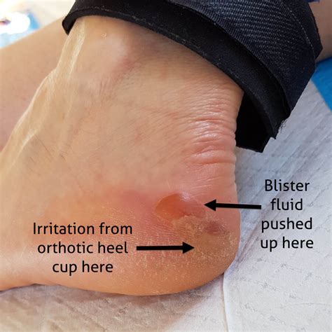 Causes of Blisters from Shoes