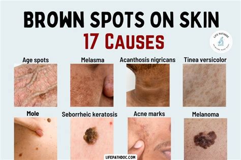 Causes of Brown Spots