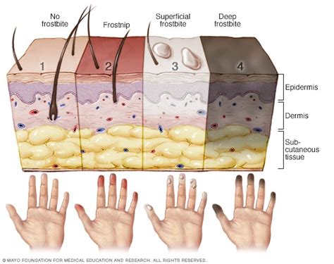 Causes of Frostbite