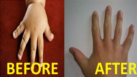 Causes of Furled Fingers