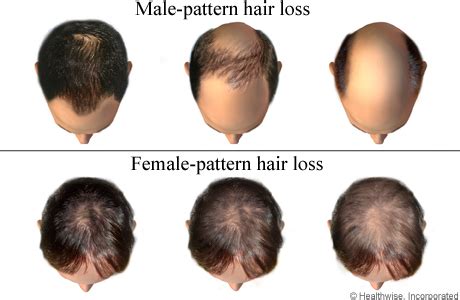 Causes of Hair Loss on Top of Head