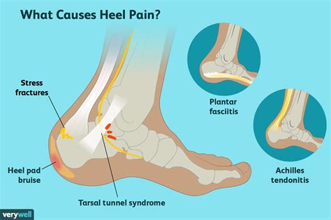 Causes of Heel Pain