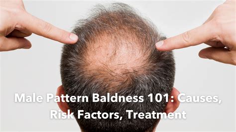 Causes of Male Pattern Baldness