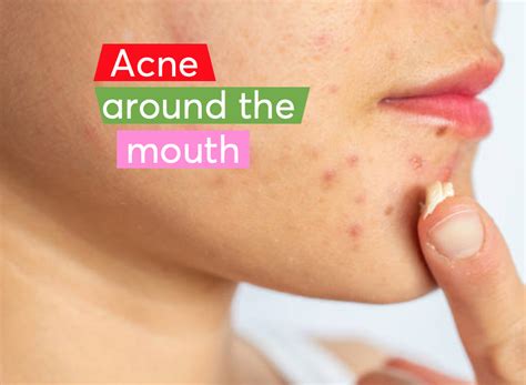 Causes of Pimples Around Mouth