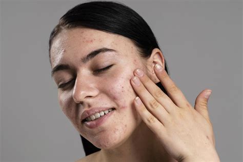 Causes of Pimples on the Face in Adults: A Comprehensive Guide