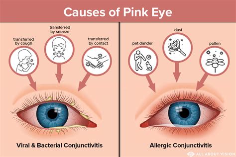 Causes of Pink Eye