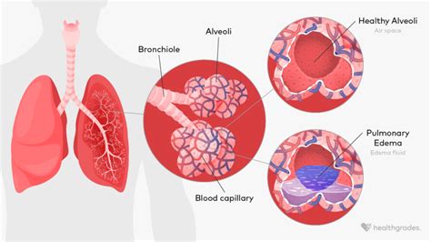 Causes of Pulmonary Congestion