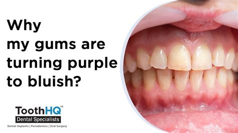 Causes of Purple Gums