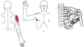 Causes of Teres Major Muscle Pain