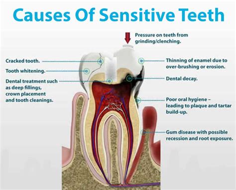 Causes of Tooth Sensitivity