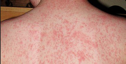 Causes of a Sudden Rash All Over the Body