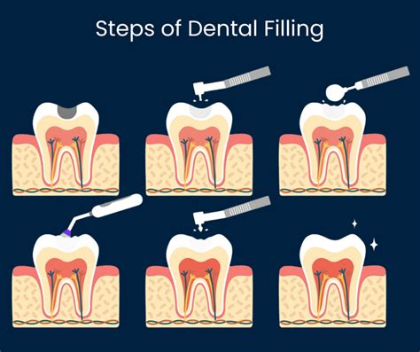 Cavity Filling in Spanish: Your Guide to Painless and Seamless Dental Care