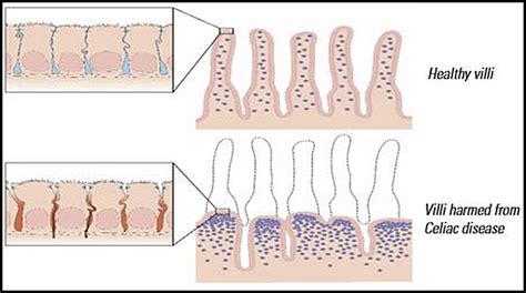 Celiac Disease Clinical Gastroenterology Doc