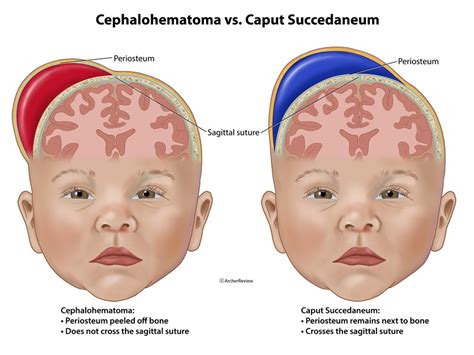 Cephalohematoma vs Caput Succedaneum: A Comprehensive Guide for Healthcare Professionals