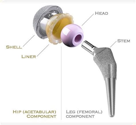 Ceramic Bearings: The Future of Joint Replacement